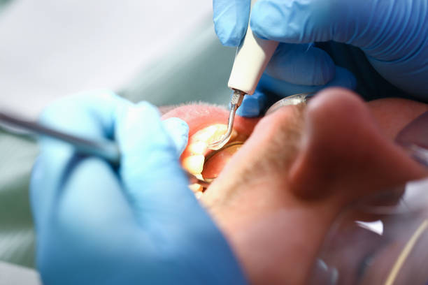 Best Chipped Tooth Repair Near Me  in Appalachia, VA